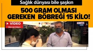 Doktarlar bile şaşkın: 500 gram olması gereken böbreği tam 15 kilo .