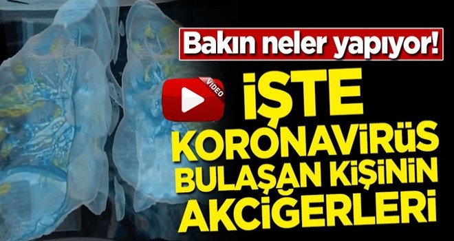 Bakın neler yapıyor! İşte koronavirüs bulaşan kişinin akciğerleri